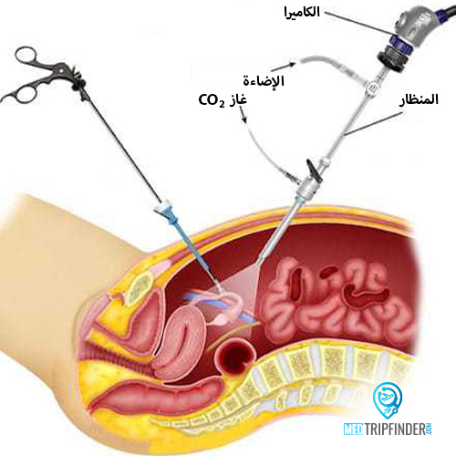 استئصال الرحم بالصور